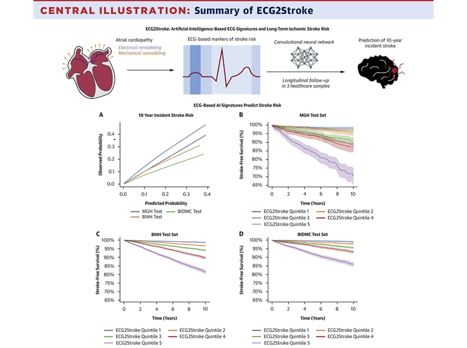 Image: Summary of ECG2Stroke (Rahul Mahajan et al. JACC (2026). DOI: 10.1016/j.jacc.2026.03.084)