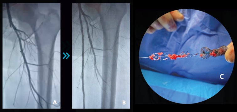 Image: Bacharach MJ, Bacharach T. Successful Removal of 20 cm SFA Thrombus With the Pounce Thrombectomy System. Endovascular Today. 2022;21(12 Suppl):S12-13