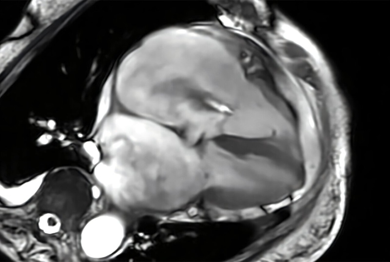 Image: Representative cine-CMR four-chamber image demonstrating severe tricuspid regurgitation (Photo courtesy of Dr. Robert Zhang) Image: Representative cine-CMR four-chamber image demonstrating severe tricuspid regurgitation (Photo courtesy of Dr. Robert Zhang)