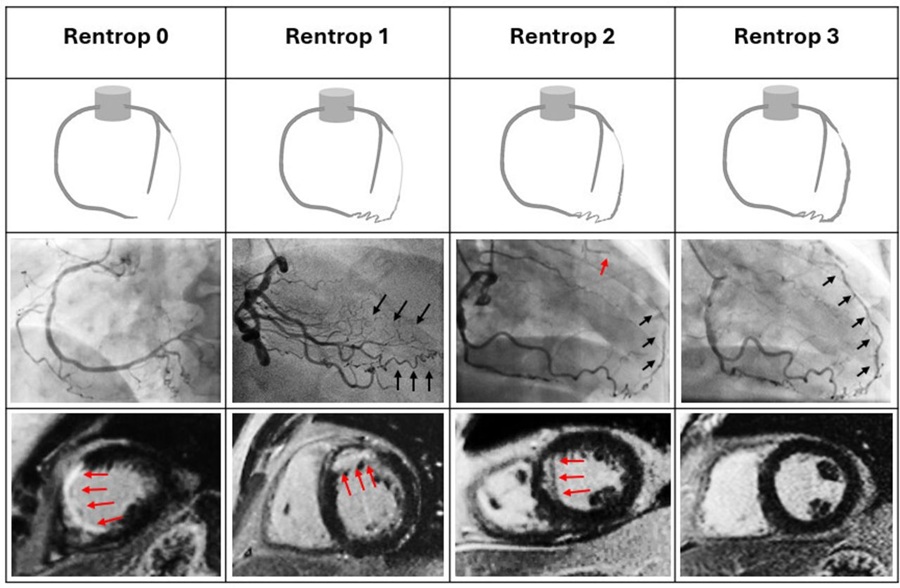 Image: Schematic and coronary angiographic examples illustrating collateral vessel grading using the Rentrop classification, alongside short-axis LGE images of the left ventricle demonstrating the presence of myocardial scar (Mehmood Z, Suresh P, Li R, et al. Open Heart (2026). DOI: 10.1136/openhrt-2025-003930)
