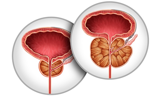 Image: Benign prostatic hyperplasia is a noncancerous prostate enlargement that can cause lower urinary tract symptoms and disrupt daily life (Photo courtesy of Adobe Stock)