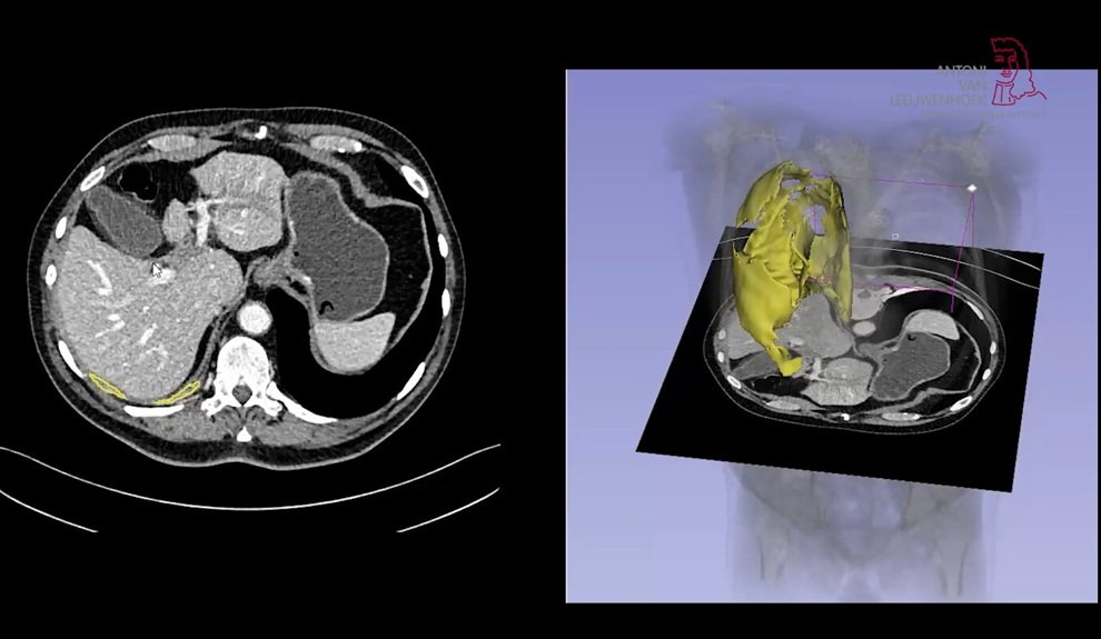 Image: The NKI-developed AI model ARTIMES measures the entire volume of a tumor, improving pleural mesothelioma treatment and clinical trials (Photo courtesy of Netherlands Cancer Institute) Image: The NKI-developed AI model ARTIMES measures the entire volume of a tumor, improving pleural mesothelioma treatment and clinical trials (Photo courtesy of Netherlands Cancer Institute)