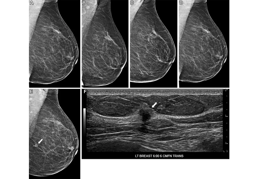 Images in a 75-year-old woman who underwent routine screening mammography in 2022. Left mediolateral oblique views shown from prior screening mammograms: (A) 2015, (B) 2018, (C) 2019, and (D) 2021. In (E) 2022, a new mass developed in the left breast at the 6-o’clock position (arrow), with a (F) corresponding irregular mass at US (arrow). Subsequent US-guided core needle biopsy yielded invasive ductal carcinoma, grade 2. The deep learning 5-year risk scores gradually increased from 2.0 (2015) to 2.1 (2018), 3.4 (2019), 3.6 (2021), and 15.3 (2022). CMFN = centimeters from nipple, LT = left, TRANS = transverse (Photo courtesy of Radiological Society of North America)