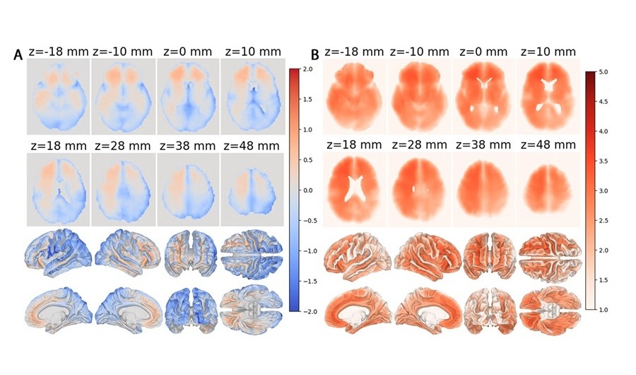 Image: AI-generated maps of local brain aging; cooler colors indicate brain regions that appear younger relative to chronological age, whereas warmer colors indicate regions that appear older. Compared with cognitively normal adults (left), people with cognitive impairment (right) show substantially more widespread patterns of advanced local brain aging, particularly in frontal and temporal brain regions. (Photo courtesy of Andrei Irimia Laboratory, University of Southern California)