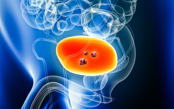 Image: New research shows incorporating AI-based risk assessment into routine clinical data could help identify bladder cancer at its earliest, most treatable stages (Image Credit: iStock)