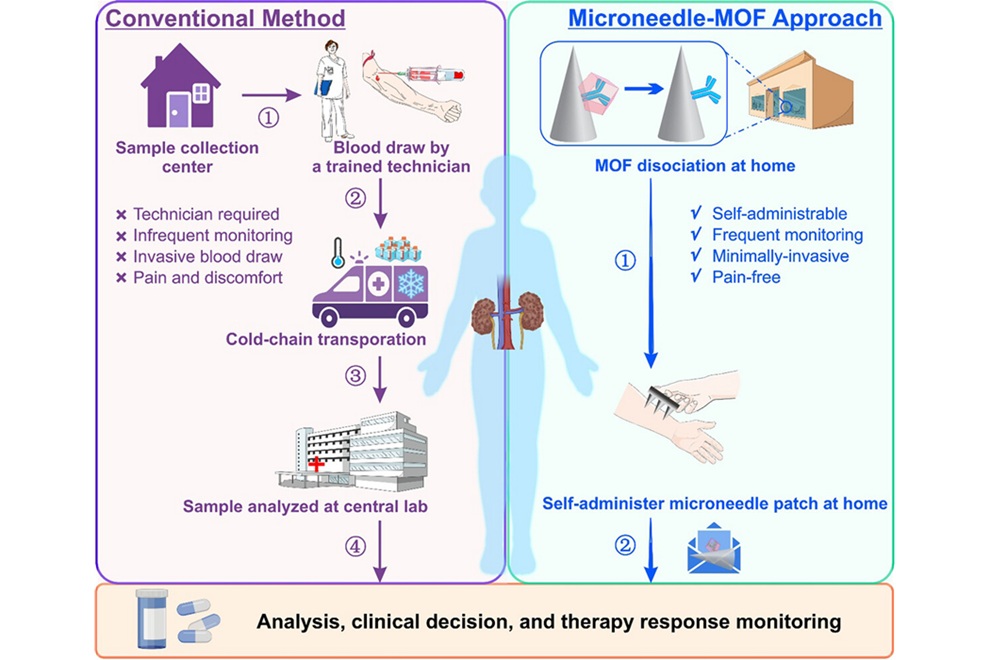 Image: Schematic illustration depicting MOF-encapsulated microneedle biosensing versus conventional blood draw-based diagnosis and monitoring of acute kidney injury. (Yixuan Wang et al.,  Advanced Materials, 2026. DOI: 10.1002/adma.74423)