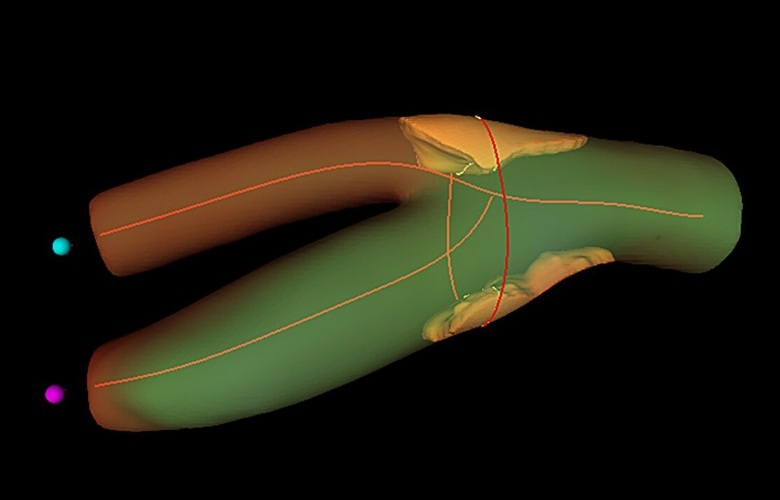 Image: 3D view of carotid atheroma plaques in a REACT study participant. (Image Credit: CNIC)