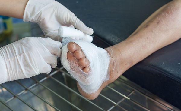 Image: Diabetic foot ulcers are hard-to-heal wounds that increase infection, hospitalization, and amputation risk, while standard cleaning and dressing do not address the inflammatory biology blocking closure. (Image Credit: Adobe Stock)