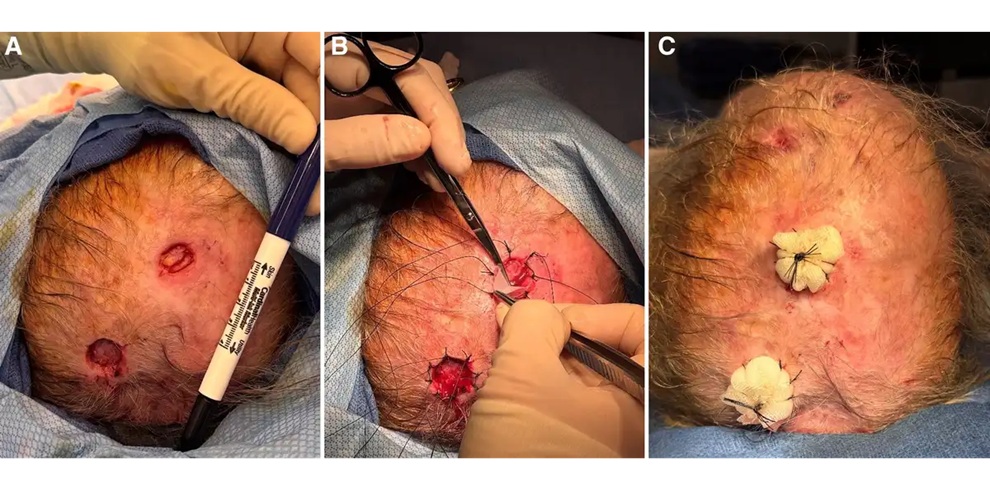 Image: DermiSphere application and tie-over bolster placement following Mohs excision. A, Postoperative appearance of the defects following Mohs excision. B, Application of DermiSphere to the wounds with sutures placed for tie-over bolster dressing fixation. C, Tie-over bolster dressing in place following DermiSphere application. (Mejia, N., Knauer, G., Parikh, S., Chang, A. H., Cataneo, J., Tripodi, G., Patel, S. A., & Walchak, A. Plastic and Reconstructive Surgery - Global Open (2026), https://doi.org/10.1097/GOX.0000000000008092)