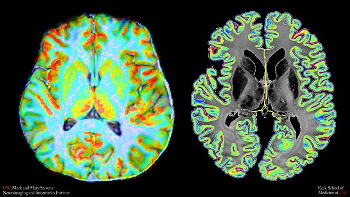 Image: A color map of blood flow through the brain, captured at high resolution with a 7 Tesla MRI scanner. Right: A map showing how densely cells are packed across the brain\'s outer layers, based on a detailed reference brain atlas. Comparing these two views allowed researchers to create CCSI, the study\'s new measure of how closely blood supply matches brain cells\' energy needs. (Photo courtesy of Stevens INI)