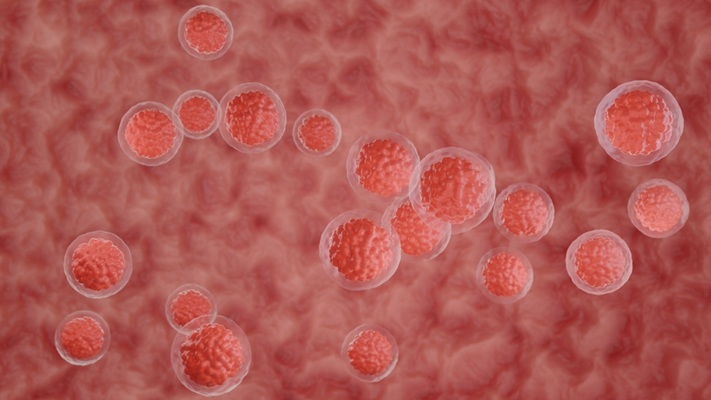 Image: The findings suggest that hematopoietic cell transplantation may benefit patients with Shwachman-Diamond syndrome soon after high-risk features are detected, before advanced malignancy develops. (Image Credit: Shutterstock) Image: The findings suggest that hematopoietic cell transplantation may benefit patients with Shwachman-Diamond syndrome soon after high-risk features are detected, before advanced malignancy develops. (Image Credit: Shutterstock)
