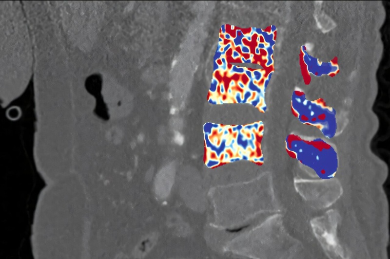Image: Cross section of the spine with a color-coded density map. Trabecular bone density decreases from blue through yellow to red. The scale ranges from red (0 mg/mm³) to blue (800 mg/mm³). (Image Credit: Fraunhofer IGD)