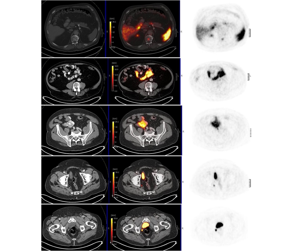 Image: Initial PSMA PET/CT scan showing (from top to bottom) positive lesions in T11, an aortocaval node, a right common iliac node, a right internal iliac node, and the prostate bed. The T11 lesion was identified as a hemangioma on a subsequent MRI. MRI indicates magnetic resonance imaging; PET/CT, positron-emission tomography/computed tomography; PSMA, prostate-specific membrane antigen. (Kishan AU, Zekster Y, Singer AE, et al. CA: A Cancer Journal for Clinicians. 2026. doi:10.3322/caac.70111)