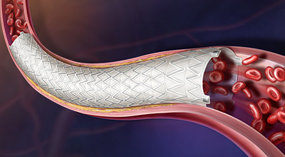 Image: The Revello Vascular Covered Stent is designed to combine the flexibility of a self-expanding nitinol stent with radial resistive force tailored to the iliac arteries. (Photo courtesy of BD) Image: The Revello Vascular Covered Stent is designed to combine the flexibility of a self-expanding nitinol stent with radial resistive force tailored to the iliac arteries. (Photo courtesy of BD)