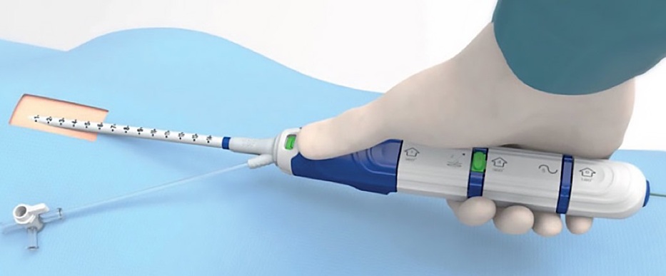 Image: PerQseal Elite provides sutureless, large-bore vascular closure after structural heart and endovascular procedures performed with 14–22F sheaths. (Photo courtesy of Vivasure Medical)