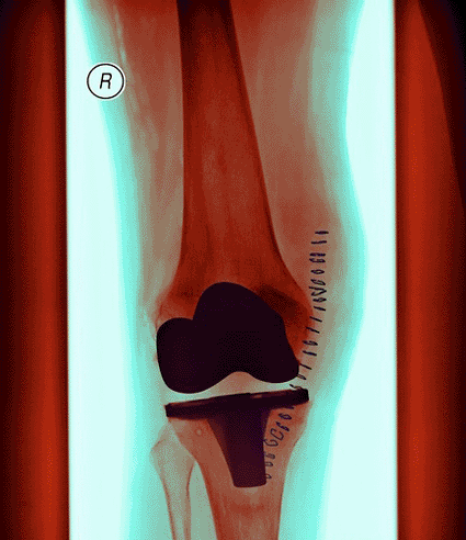Image: Colored frontal X-ray of a patient's right leg, showing a knee implant (Photo courtesy of Gustoimages).