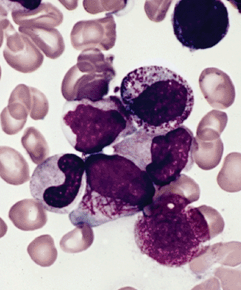 Image: Bone marrow smear from a patient with hypergranular acute promyelocytic leukemia (Photo courtesy of the Armed Forces Institute of Pathology).