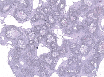 Image: Histopathology of papillary craniopharyngioma (Photo courtesy of Jensflorian).