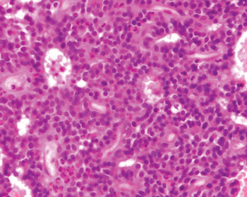 Image: Photomicrograph of solid ovarian carcinoma (Photo courtesy of University of Guelph).