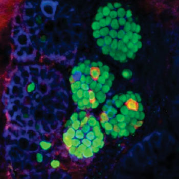 Image: Insulin-expressing cells (red) arising within the intestinal crypts (green) of a mouse that received three beta-cell “reprogramming factors” (Photo courtesy of Dr. Ben Stanger, University of Pennsylvania).