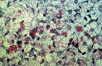 Image: A photomicrograph of Mycobacterium leprae, the small brick-red rods, taken from a leprosy skin lesion (Photo courtesy of Centers of Disease Control and Prevention).