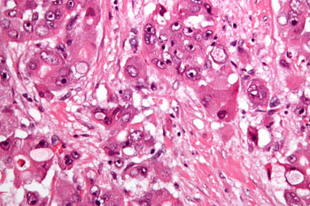 Image: Very high magnification micrograph of fibrolamellar hepatocellular carcinoma showing the characteristic laminated fibrosis between the tumor cells with a low N/C ratio. H&E stain (Photo courtesy of Wikimedia Commons). Image: Very high magnification micrograph of fibrolamellar hepatocellular carcinoma showing the characteristic laminated fibrosis between the tumor cells with a low N/C ratio. H&E stain (Photo courtesy of Wikimedia Commons).