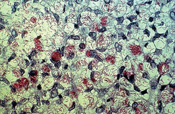 Микрофотография Mycobacterium leprae – маленькие кирпично-красные палочки, взятые из пораженной лепрой кожи (фото любезно предоставлено Центрами контроля и профилактики заболеваний). Микрофотография Mycobacterium leprae – маленькие кирпично-красные палочки, взятые из пораженной лепрой кожи (фото любезно предоставлено Центрами контроля и профилактики заболеваний).