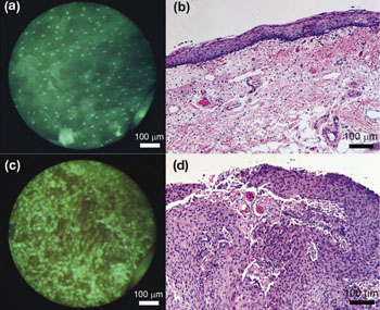 图片：高分辨率光纤内窥显微镜显示的活检样本组织特征与传统的组织学检查相同。健康口腔粘膜：(a)内窥显微镜；(b)传统组织学。口腔癌：(c)内窥显微镜；(d)传统组织学（图片蒙美国国家卫生研究所惠赐）。