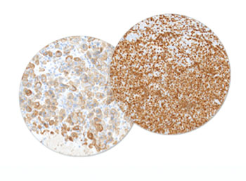 图片：新型的CK8/18和TdT优质抗体（图片蒙Dako公司惠赐）。