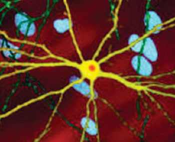 Image: A microscope image of a neuron with inclusion (stained orange) caused by Huntington\'s disease (Photo courtesy of Wikimedia Commons).