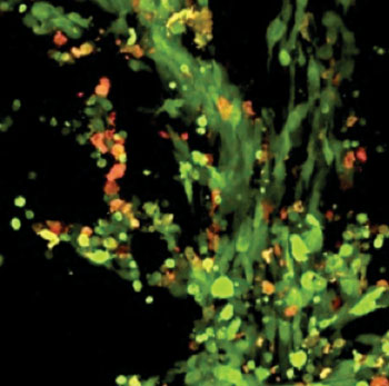 Image: In mice whose brain tumor cells (in green) could not make galectin-1, the body’s immune system was able to recognize and attack the cells, causing them to die. In this microscope image, the orange areas show where tumor cells had died in just the first three days after the tumor was implanted in the brain. Six days later, the tumor had been eradicated (Photo courtesy of the University of Michigan).