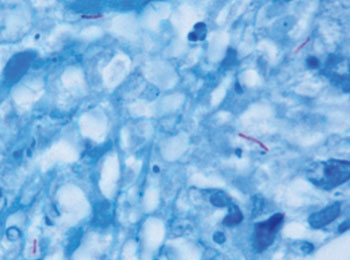 M. tuberculosis (окрашен красным цветом) в ткани (синий цвет).  Фото любезно предоставлено фондом Wikimedia.