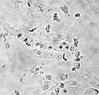 Image: Photomicrograph of urine sample with many hyaline and cellular casts intermingled with each other (Photo courtesy of the Catholic University of Korea).