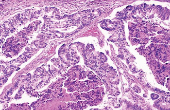 Histopathology of colonic adenocarcinoma; the glands are enlarged and filled with necrotic debris (Photo courtesy of the University of Utah).