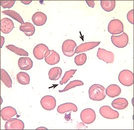 Image: Peripheral blood smear of a patient with hemoglobin SS disease. Arrows indicate classic sickle cells (Photo courtesy of the University of North Carolina).