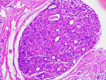 Image: Histopathology of cribriform type ductal carcinoma in situ (DCIS) of the breast (Photo courtesy of Difu Wu).