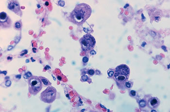 Image: Cytomegalovirus infection with basophilic nuclear inclusions with perinuclear halo and granular basophilic cytoplasmic inclusions (Photo courtesy of Dr. Yale Rosen, MD).