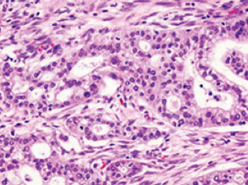 Image: Micrograph of pancreatic ductal adenocarcinoma (the most common type of pancreatic cancer) (Photo courtesy of Wikimedia Commons).