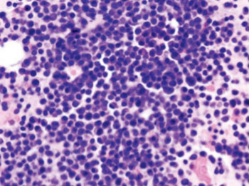Image: Micrograph of bone marrow aspirate showing the histological correlate of multiple myeloma (Photo courtesy of Wikimedia Commons).