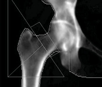 Изображение тазобедренного сустава, полученное при проведении двухэнергетической рентгеновской абсорбциометрии для измерения плотности костной ткани (фото любезно предоставлено доктором Энтони Морроу (Anthony Morrow)).
