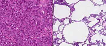 Image: Left panel: Micrograph of an undifferentiated breast tumor - densely packed with cancerous cells and with a high potential to spread. Right panel: Differentiated tumor following anti-Malat1 ASO treatment with cyst-like cells filled with fluid containing, among other things, milk proteins. Treated tumors were comparatively static with reduced metastatic activity (Photo courtesy of Spector Laboratory, Cold Spring Harbor Laboratory).