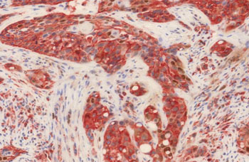 Image: Section of a head and neck cancer biopsy was stained for p21 (brown) and for S6 phosphorylation (red). S6 phosphorylation depends directly on mTOR and, therefore, its detection is an indication of mTOR activity (Photo courtesy of Centro Nacional de Investigaciones Oncologicas).