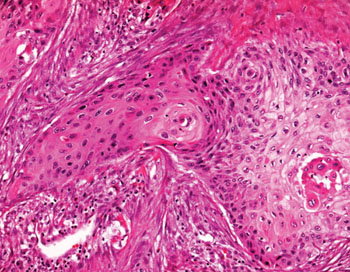 图片：非小细胞肺癌的组织病理学（照片由Genome Pathology提供）。