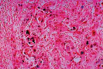 Image: Immunohistochemistry showing in situ hybridization positive for human papilloma virus HPV16/18 in this anal carcinoma histology specimen (Photo courtesy of International Agency for Cancer Research).