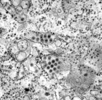 Image: The transmission electron micrograph (TEM) shows a number of round Dengue virus particles in this tissue specimen (Photo courtesy of the CDC – US Centers for Disease Control and Prevention).