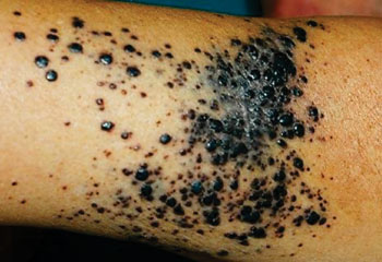 图片：将局部复发的临床特征定义为切口疤痕或植入物内或相邻区域再次出现黑色素瘤，且带有原位成分（图片蒙Paola Savoia博士惠赐）。