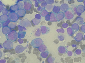 Image: A photomicrograph of myeloblasts in bone marrow of patient with acute myeloid leukemia (AML) (Photo courtesy of Wikimedia Commons).