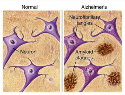 Схематическое изображение образования амилоидных бляшек в головном мозге, пораженном болезнью Альцгеймера, по сравнению со здоровым мозгом (фото любезно предоставлено Юнджи Такано (Junji Takano)).