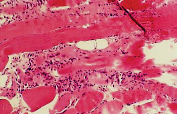 Image: A histopathology of polymyositis showing endomysial mononuclear inflammatory infiltrate and muscle fiber necrosis (Photo courtesy of Ramesh Pappu, MD, DPH).