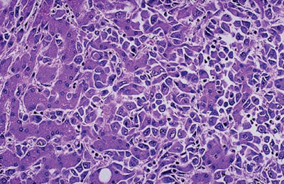图片：肝细胞癌的组织病理图，大多数恶变细胞集中在右边，与大多数在左边的较大的正常肝细胞交织但能清楚分辨（图片蒙犹他大学医学院惠赐）。